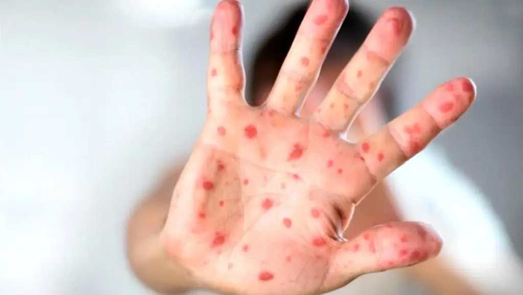 Sube a 12 los casos acumulados de sarampión en Tabasco; Salud mantiene medidas preventivas