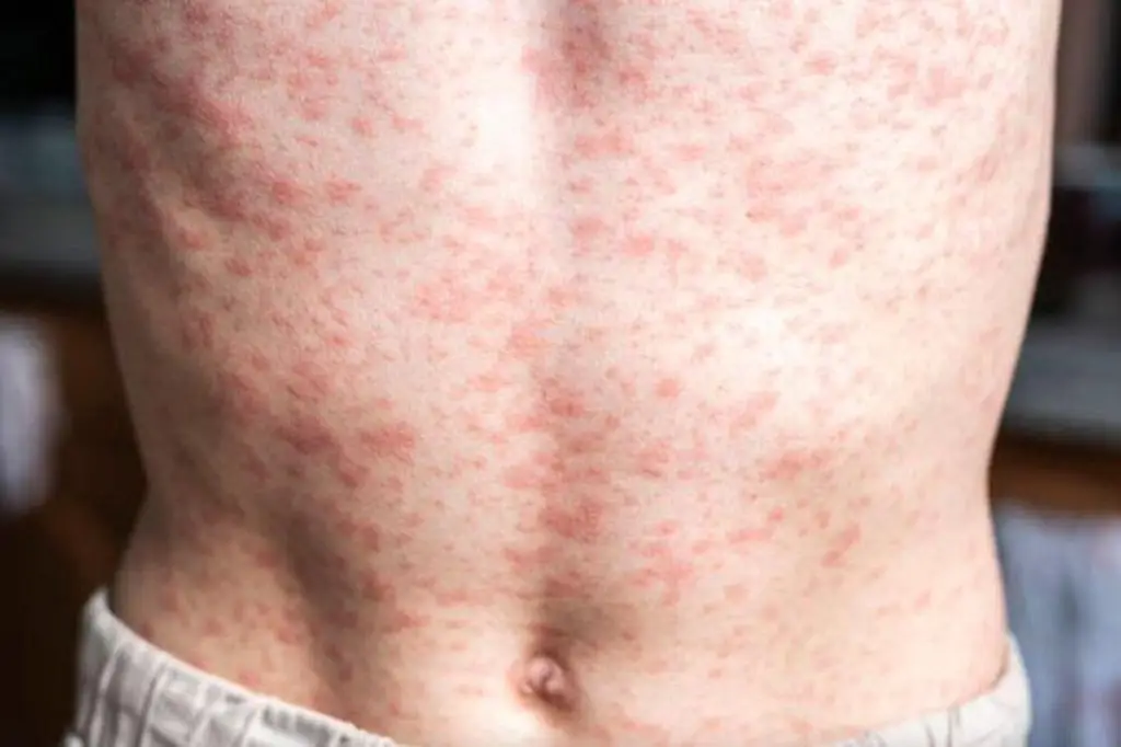 Fallece bebé por sarampión en Tlaxcala; no estaba vacunado  