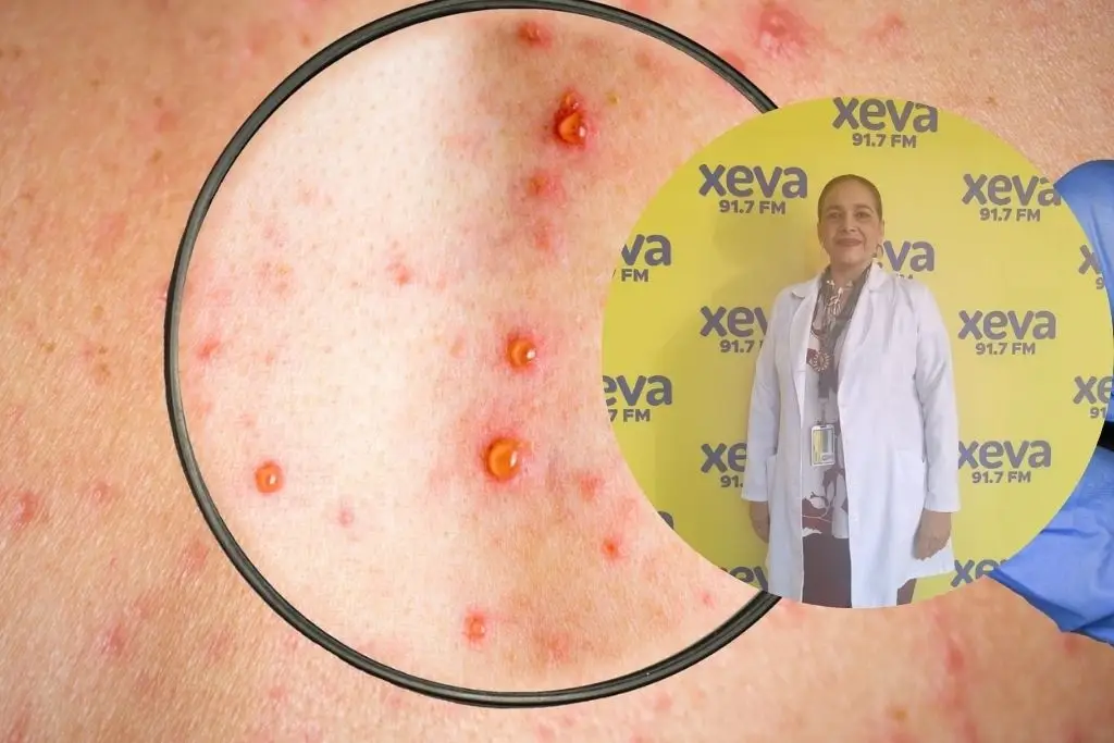 Llamado del IMSS: Vacúnate contra el sarampión este fin de semana