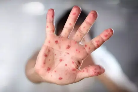 OPS alerta a México por el sarampión: aumentan los casos y muertes por este virus